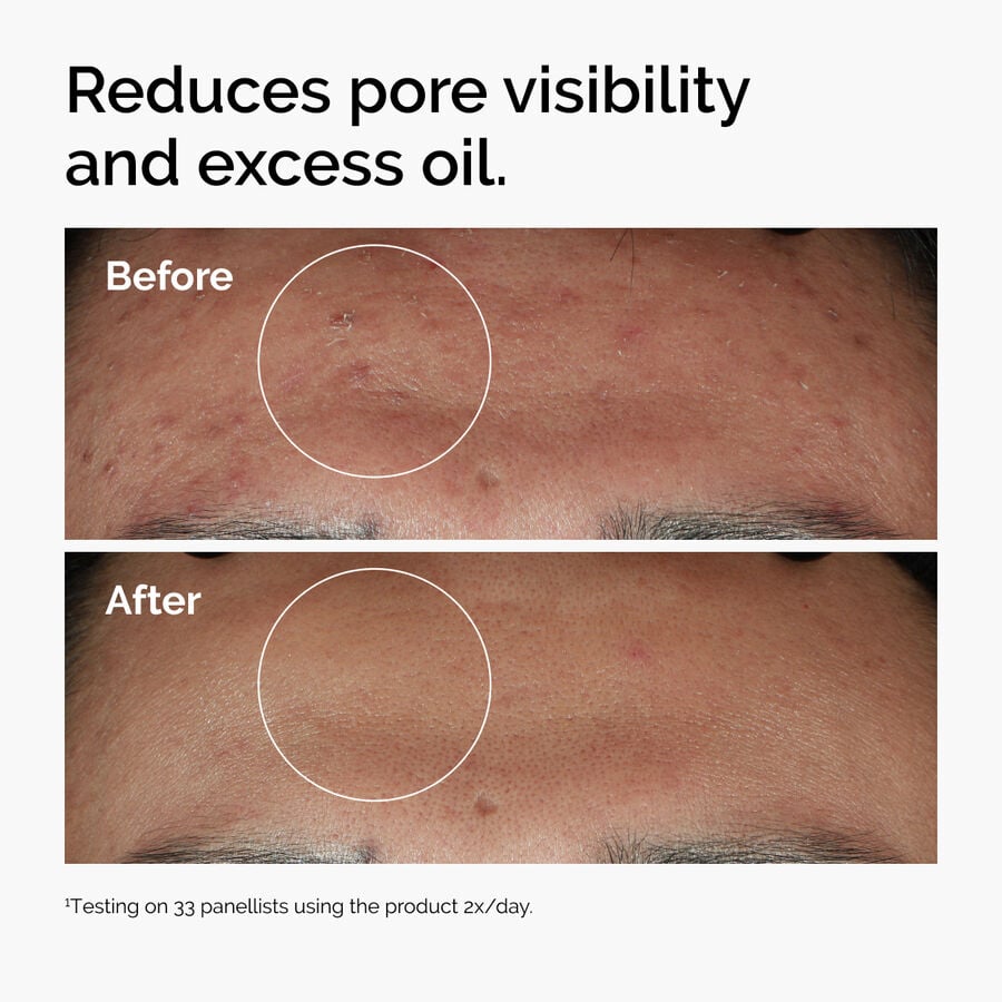 niacinamide-10-zinc-1-w5 ord-niacinamide-zinc-blemish-serum-before-after-pores.jpg