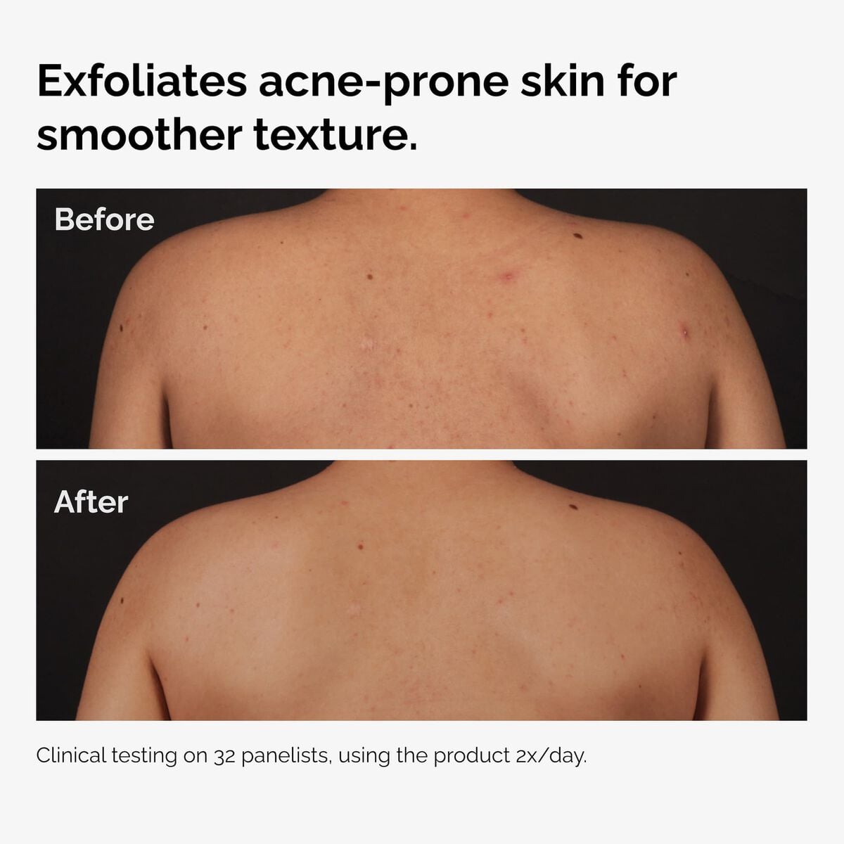 salicylic-acid-0-5-body-serum-c4 ord-salicylic-acid-body-serum-before-after-graphic-NA.jpg
